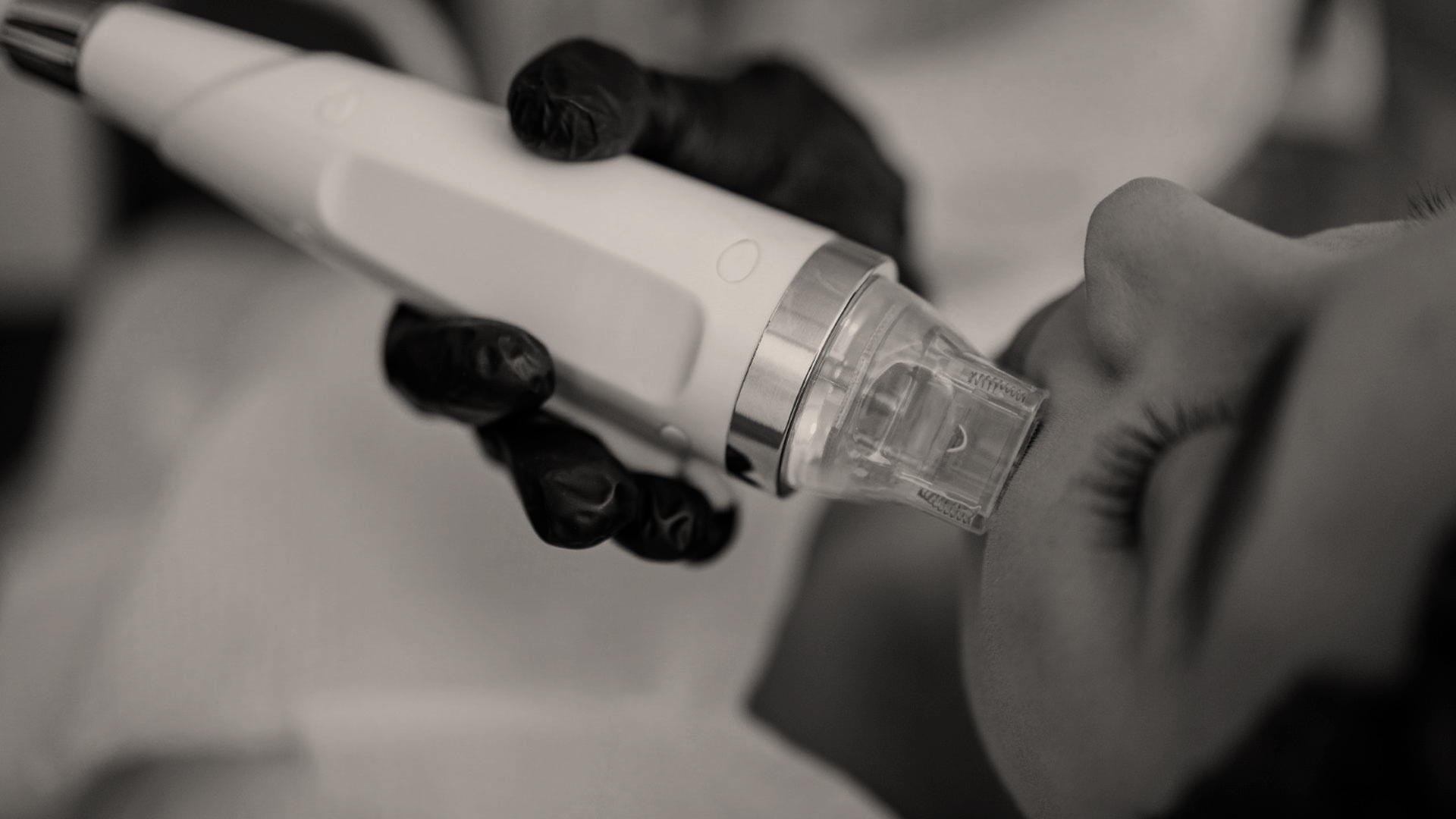 Radiofrequenz Needling